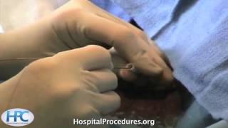 Femoral Line Video