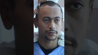 Hair Transplant Result After 10 Days - MOHAMMED ABBAS Hair Transplant Experience