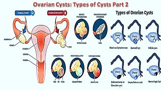 Ovarian Cysts Types Part 2