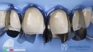 Anterior direct composite restoration performed by Dr  Manauta with Unica anterior matrix