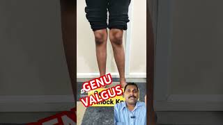 GENU VALGUS