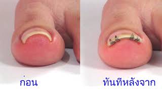 Thai v2: อุปกรณ์ป้องกันเล็บขบ "NailLift"