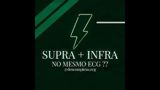 Descomplexo ECG: Supra e Infra no mesmo eletro, o que pensar?