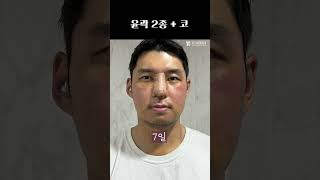 남성미 조금 줄이기🤫#plasticsurgeryinkorea