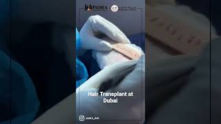 Hair Transplant in Dubai #زراعةالشعر #hairtransplantbeforeafter