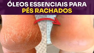 Melhores Óleos Essenciais para hidratar pés ressecados e rachados