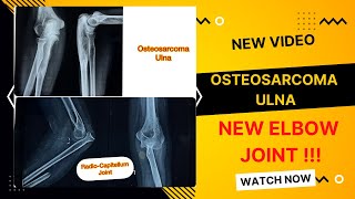 Proximal Ulna Bone Tumor Osteosarcoma