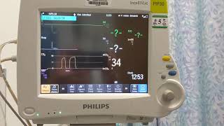 ETCO2 Set-up on Philips Monitor