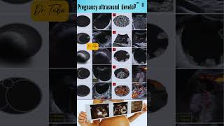 ultrasound in pregnancy development | fetal development scan #baby #ultrasound #scan #shorts