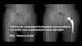 Ендопротезування кульшового суглобу, Joint surgery by doctor Roman Horobets