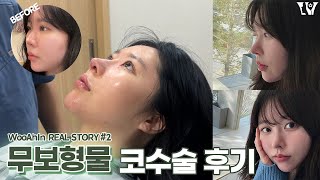 (2편) 무보형물 코수술 SSUL