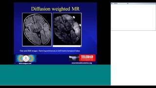 Neuro Imaging of Encephalitis by Dr Suresh K