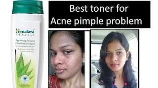 Best toner to clear Acne pimples | Get clear skin |Himalaya Herbals purifying Neem Toner| Review