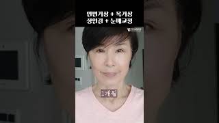 티 안나게 젊어지기 #plasticsurgeryinkorea