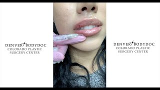 Juvederm Lip Filler Demonstration