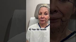 20 Years Taken Off! Facelift on a 62 Year Old 🤩