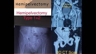 Hemipelvectomy : Life with or without Hip Joint