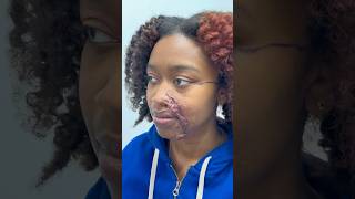 Keloid Removal For Acid Attack Survivor! #plasticsurgery