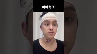 자신있게 이마까기 (남자편) #plasticsurgeryinkorea