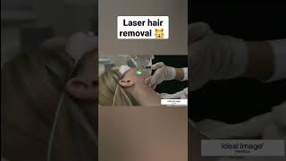 Laser hair removal 🙀