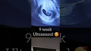 9 week Ultrasound 🥰🥰 Boy or Girl?! #9weeks #pregnancy #pregnancyjourney #ultrasound #weekbyweek