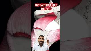 Rotator cuff repair