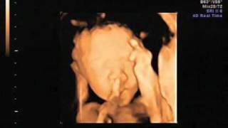 Melina Lim's 4D Ultrasound Video (25 Weeks)