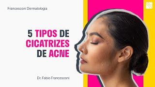 5 Tipos de Cicatrizes de Acne