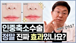 인중축소수술, 효과 있나요?ㅣ처지고 길어진 인중 개선하는 방법 (수술원리, 흉터) - 의학박사 백승준