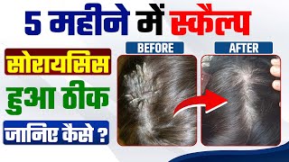 5 महीने में स्कैल्प सोरायसिस हुआ ठीक | Scalp psoriasis removal satisfying | Scalp ka ilaj