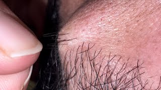 ASMR hair body relaxin vedio beards hair | ingrown 10 ingrown