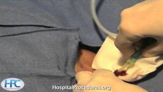 Ultrasound-guided IJ line video