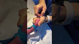 INFANT BABY IV LINE INSRATION 🩺||#health #ivfluids #injection #youtubeshorts