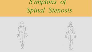 Spinal Stenosis Clinical Pattern