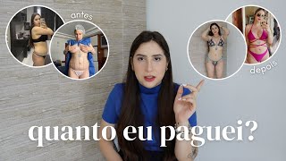 TUDO SOBRE A MINHA CIRURGIA LIPOESCULTURA E MASTOPEXIA: valores, resultado, arrependimentos & mais