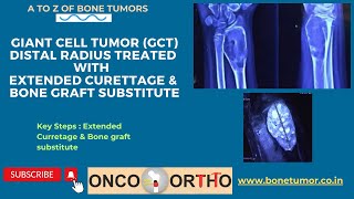 Giant Cell Tumor (GCT) of Wrist Joint or Distal Radius