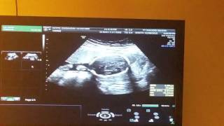 23 week ultrasound pt 5