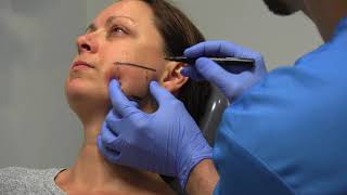 Masseter hypertrofie behandelen met botox