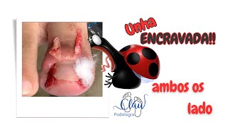 Podóloga remove UNHA ENCRAVADA dolorosa: veja o procedimento em ação #unhas #pes #dor #podologia