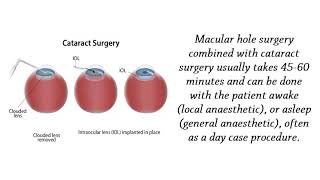 Mahi Muquit Macular Hole Surgery Specialist