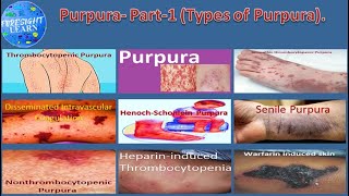 Purpura- Part 1 (Types of Purpura)