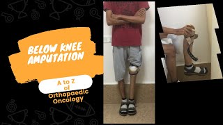 Below Knee Amputation patient with a Artificial Leg