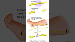 NERVE GRAFT / CABLE GRAFT = FACIAL NERVE INJURY