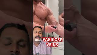 Varicose veins