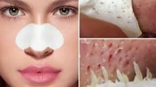 Masker Murah Mengangkat Komedo Serta Memutihkan dah Mencerahkan kulit