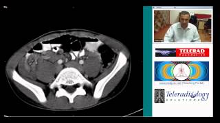 CT scan of ileocolic intusussception by Dr Arjun Kalyanpur