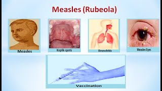 Measles(Rubeola)|measles can be cured?|Is measles chicken pox? #rubeola #measles