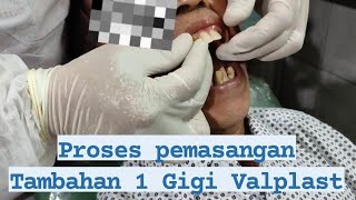 Cara PASANG GIGI PALSU VALPLAST di PASIEN dengan menambah 1 gigi depan.