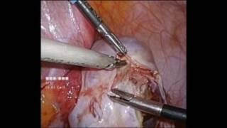 laparoscopic ovarian cystectomy