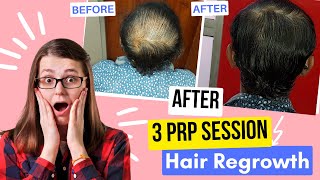 How to get your hair back ? PRP Treatment Before and After